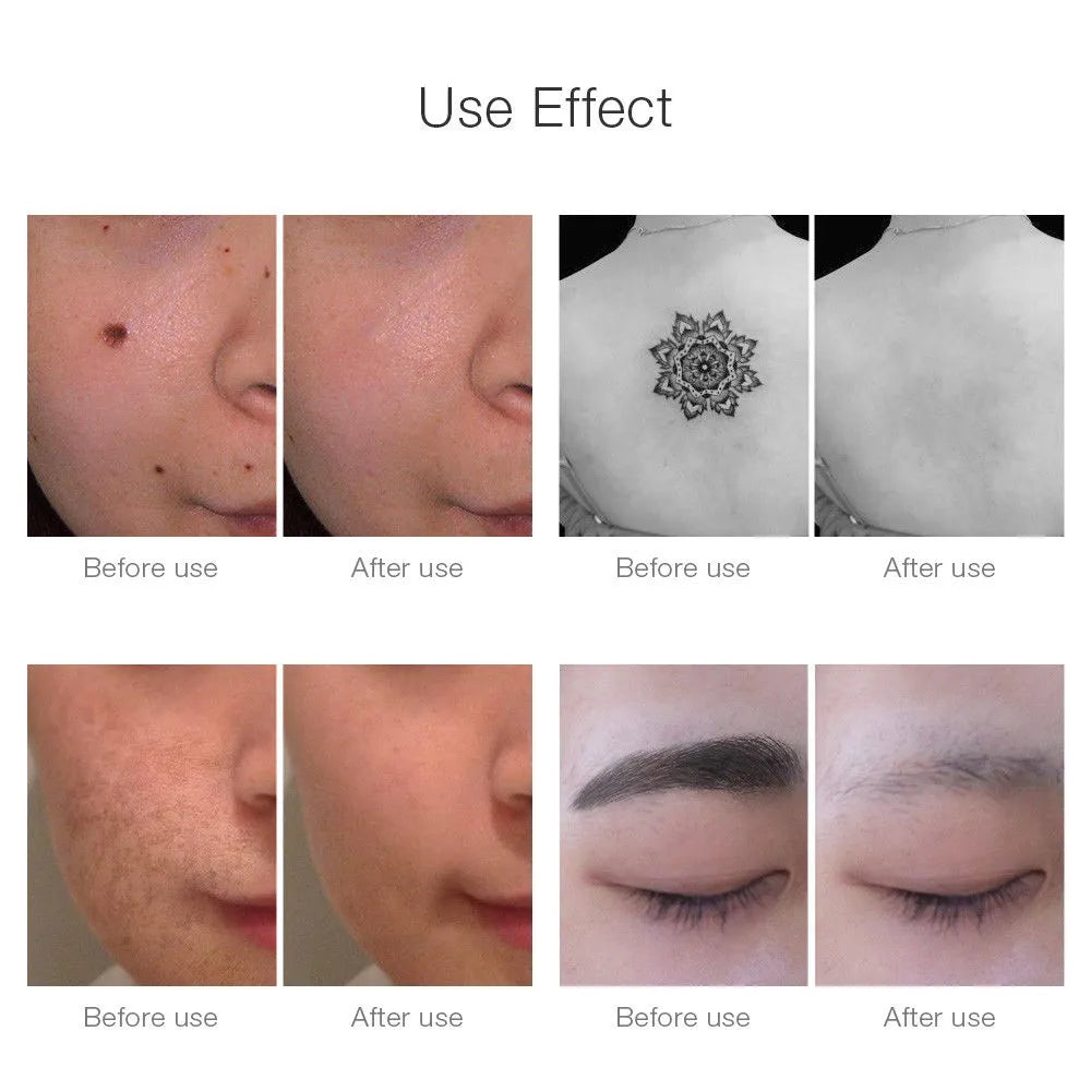 NNEOBA Neatcell Picosecond Laser Pen: Skin Care Beauty Device